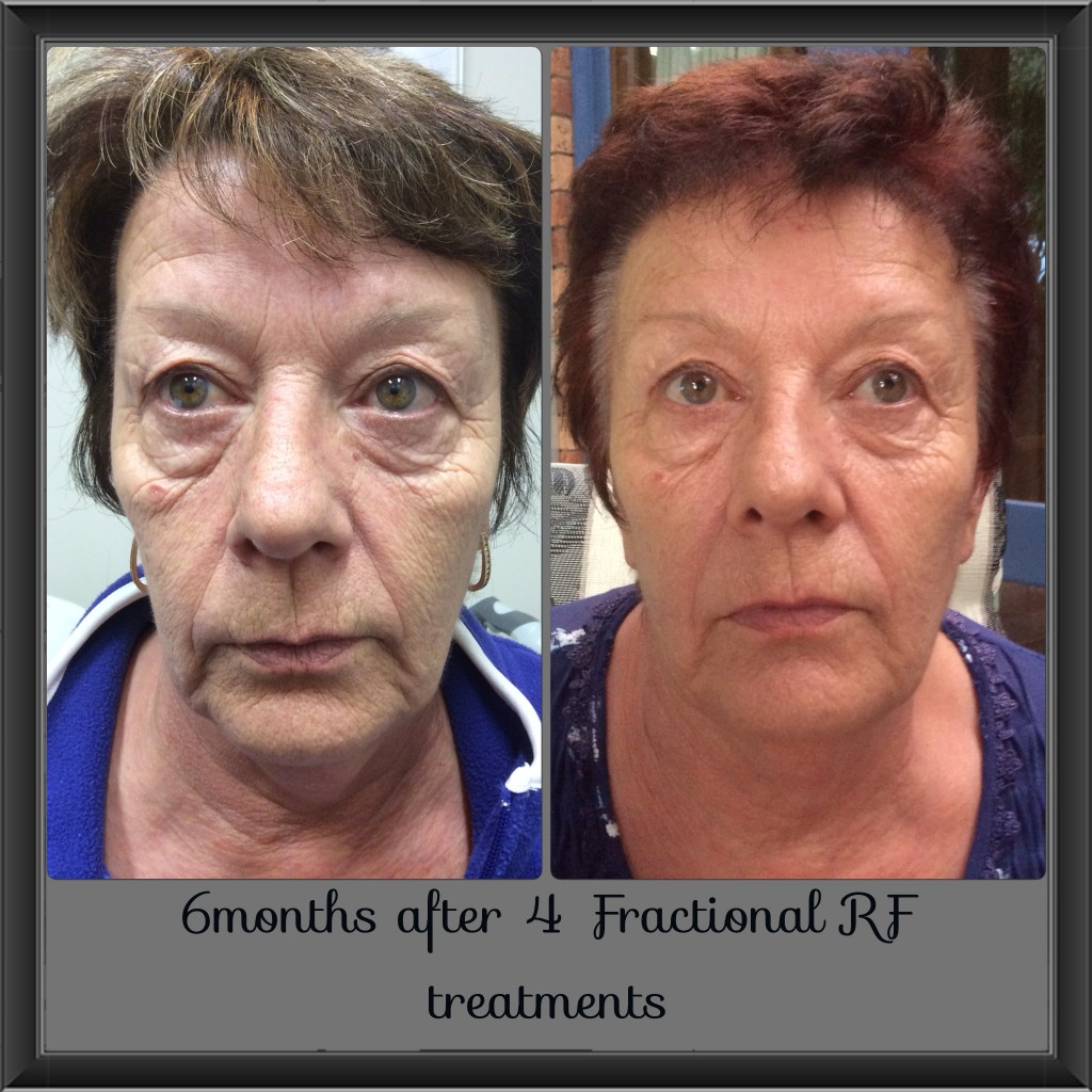 Fractional Rf Skin Treatment Narellan And Campbelltown